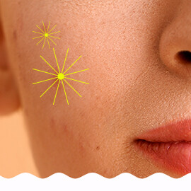 Akne, gyulladt pattanásos bőr